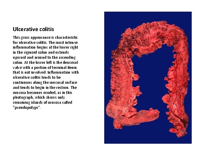 Ulcerative colitis This gross appearance is characteristic for ulcerative colitis. The most intense inflammation