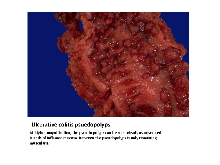 Ulcerative colitis psuedopolyps At higher magnification, the pseudo polyps can be seen clearly as