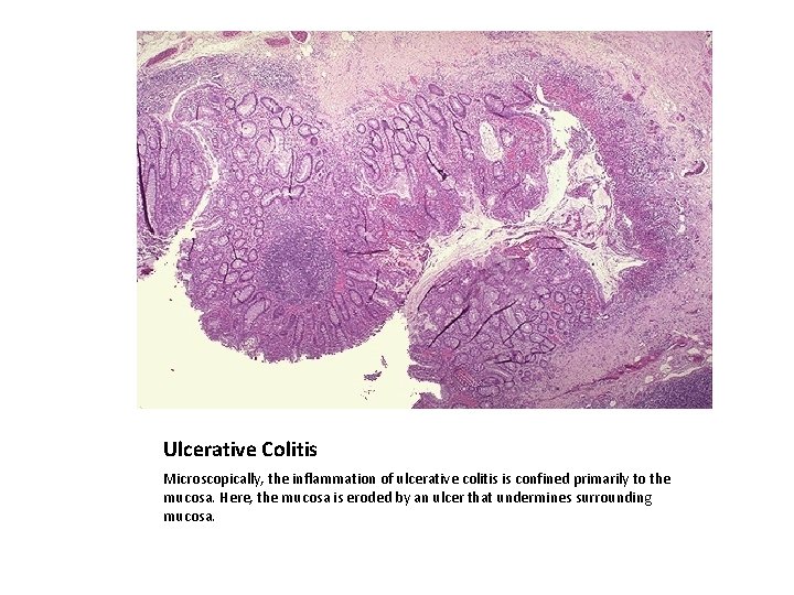 Ulcerative Colitis Microscopically, the inflammation of ulcerative colitis is confined primarily to the mucosa.