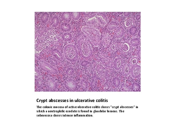 Crypt abscesses in ulcerative colitis The colonic mucosa of active ulcerative colitis shows "crypt
