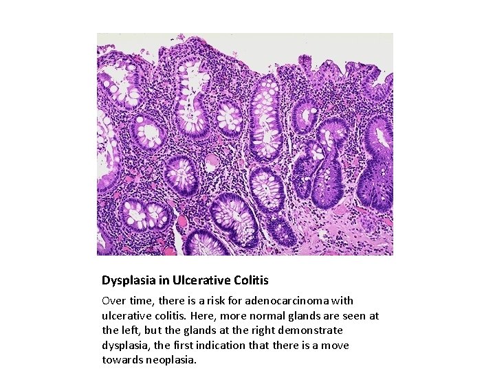 Dysplasia in Ulcerative Colitis Over time, there is a risk for adenocarcinoma with ulcerative