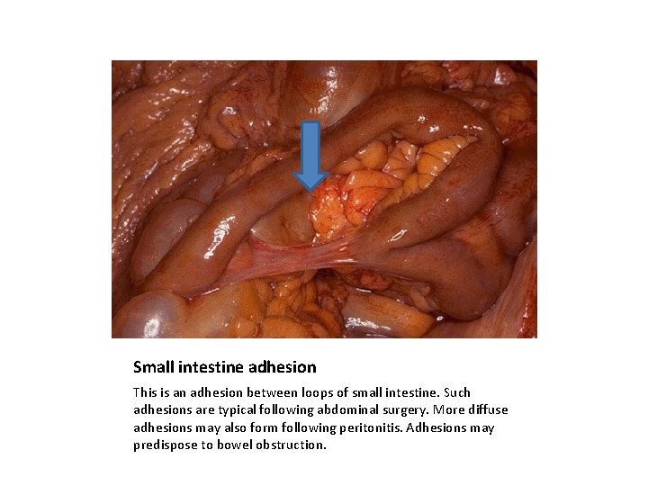Small intestine adhesion This is an adhesion between loops of small intestine. Such adhesions