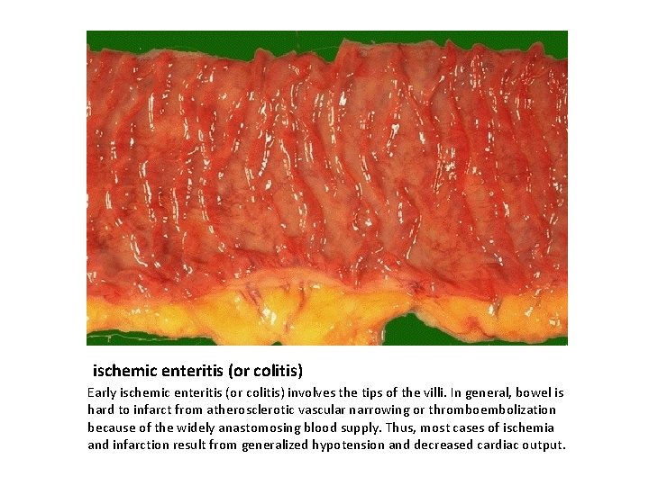 ischemic enteritis (or colitis) Early ischemic enteritis (or colitis) involves the tips of the