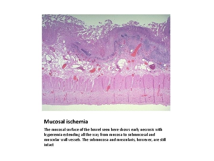 Mucosal ischemia The mucosal surface of the bowel seen here shows early necrosis with