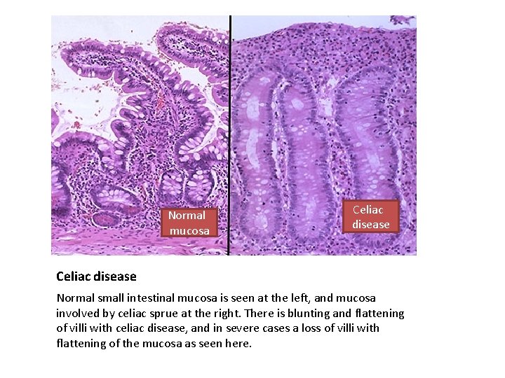 Normal mucosa Celiac disease Normal small intestinal mucosa is seen at the left, and