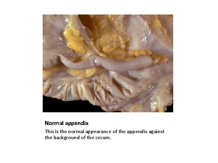 Normal appendix This is the normal appearance of the appendix against the background of
