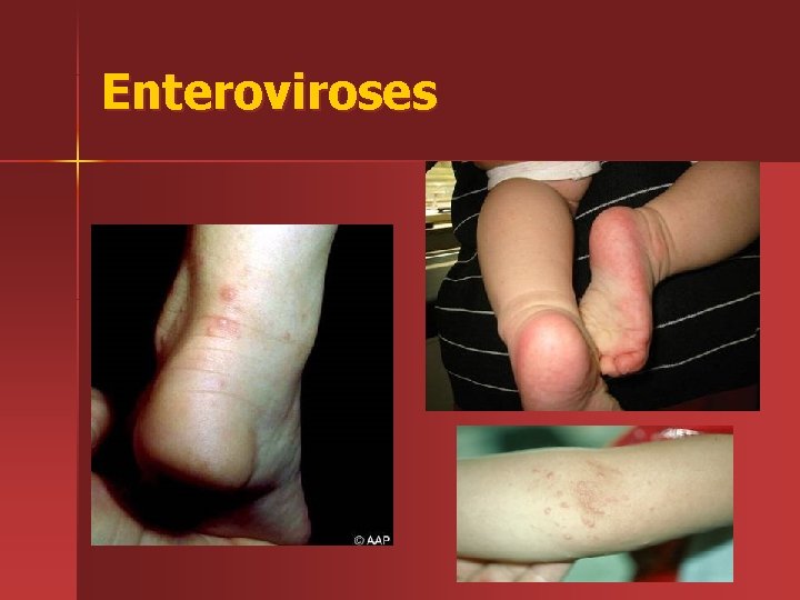 Enteroviroses 