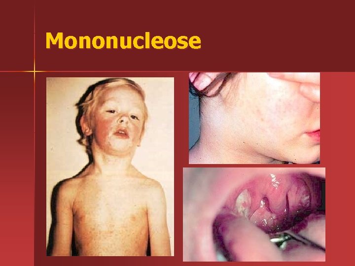 Mononucleose 