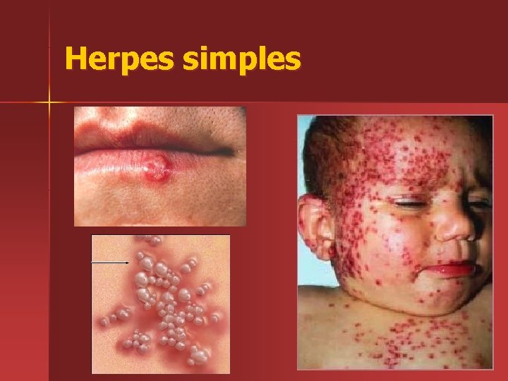 Herpes simples 