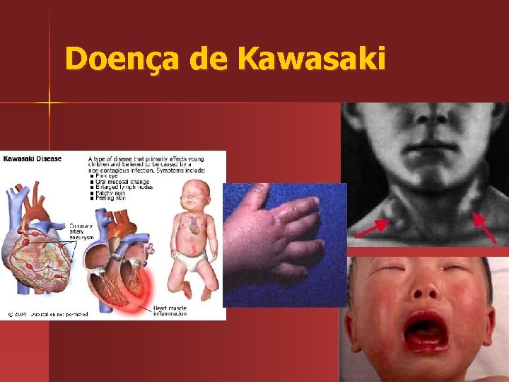 Doença de Kawasaki 