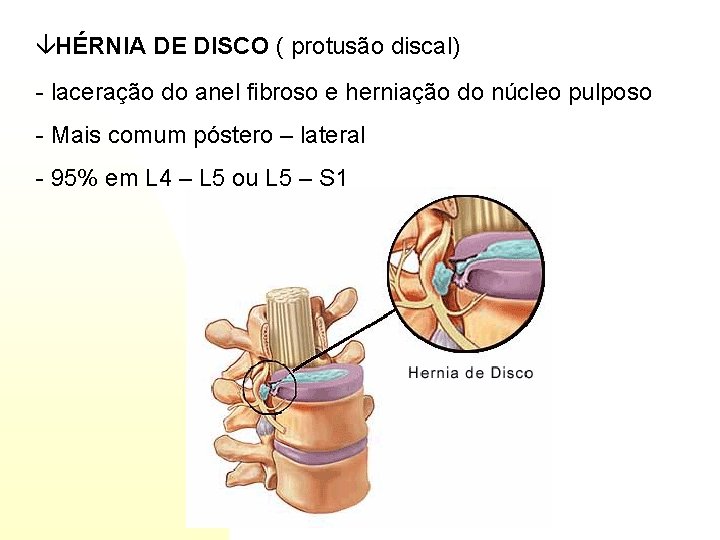 âHÉRNIA DE DISCO ( protusão discal) - laceração do anel fibroso e herniação do