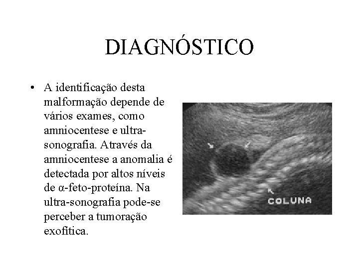 DIAGNÓSTICO • A identificação desta malformação depende de vários exames, como amniocentese e ultrasonografia.