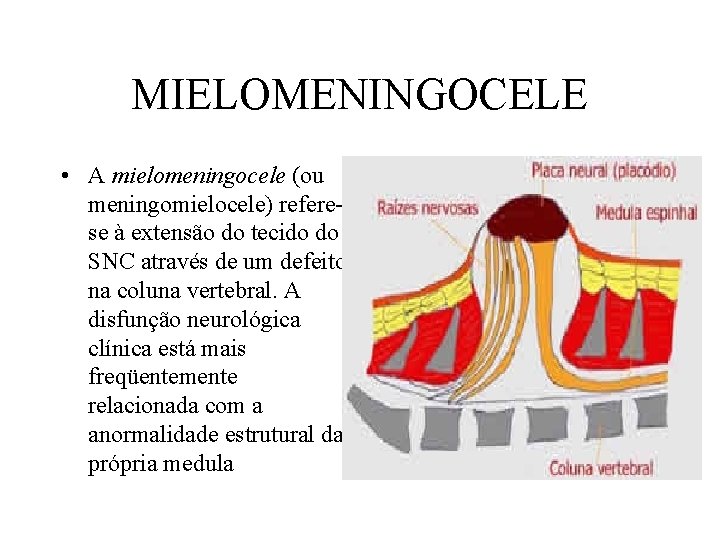 MIELOMENINGOCELE • A mielomeningocele (ou meningomielocele) referese à extensão do tecido do SNC através