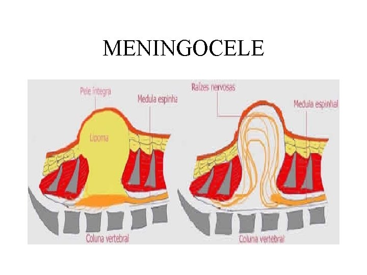 MENINGOCELE 