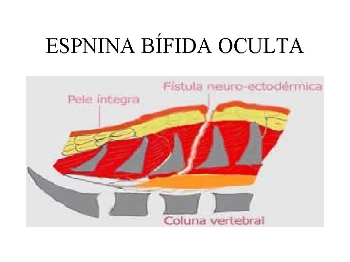 ESPNINA BÍFIDA OCULTA 