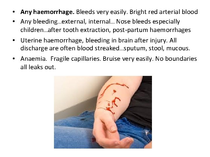 • Any haemorrhage. Bleeds very easily. Bright red arterial blood • Any bleeding…external, • Any haemorrhage. Bleeds very easily. Bright red arterial blood • Any bleeding…external,