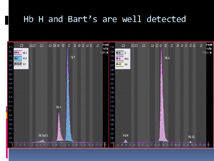 Hb H and Bart’s are well detected 