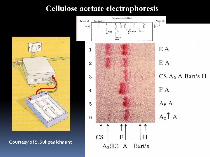 Cellulose acetate electrophoresis Courtesy of S. Sukpanichnant 