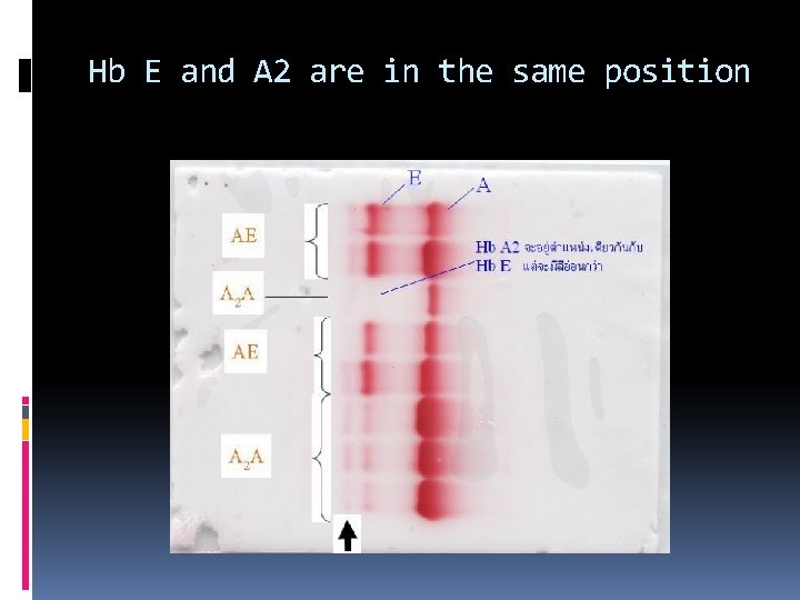 Hb E and A 2 are in the same position 