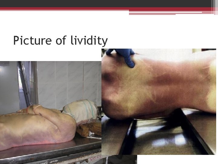 Picture of lividity 