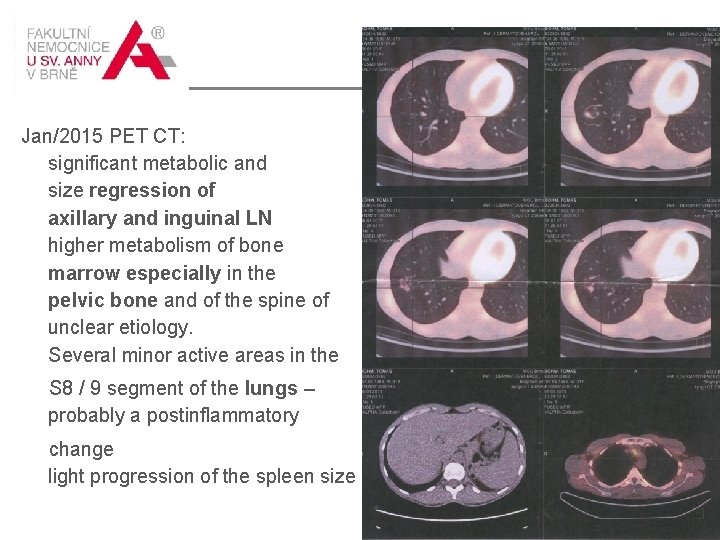 1/2015 Jan/2015 PET CT: significant metabolic and size regression of axillary and inguinal LN