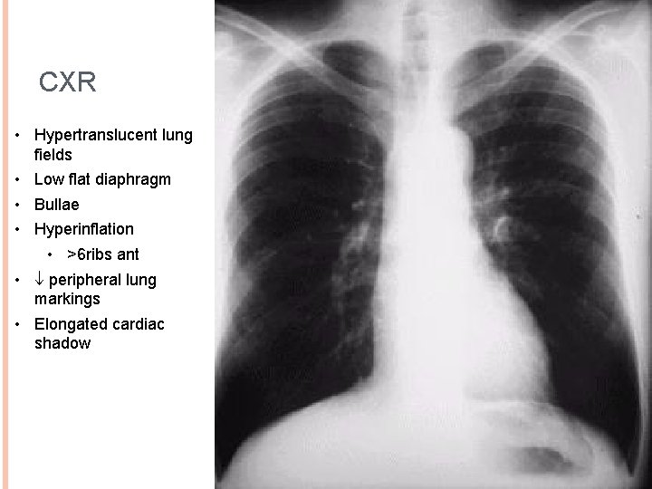 CXR • Hypertranslucent lung fields • Low flat diaphragm • Bullae • Hyperinflation •