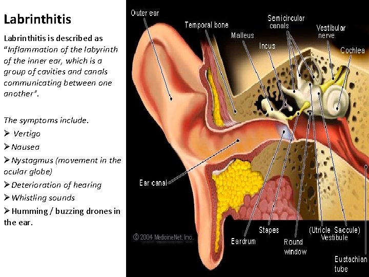 Labrinthitis is described as “Inflammation of the labyrinth of the inner ear, which is