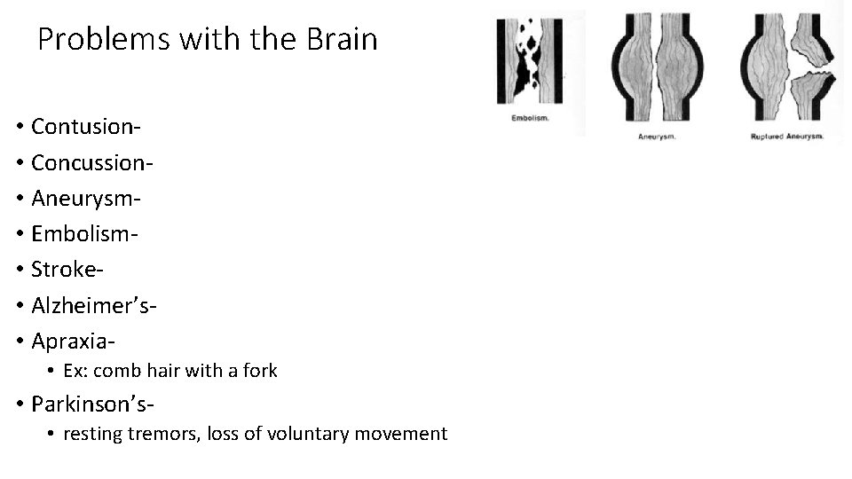 Problems with the Brain • Contusion • Concussion • Aneurysm • Embolism • Stroke