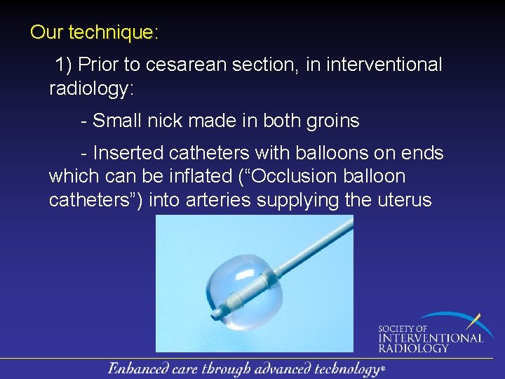 Our technique: 1) Prior to cesarean section, in interventional radiology: - Small nick made