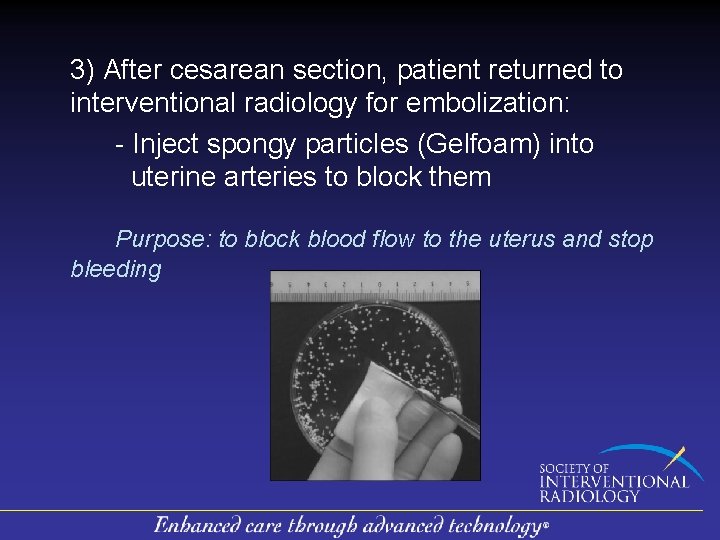 3) After cesarean section, patient returned to interventional radiology for embolization: - Inject spongy