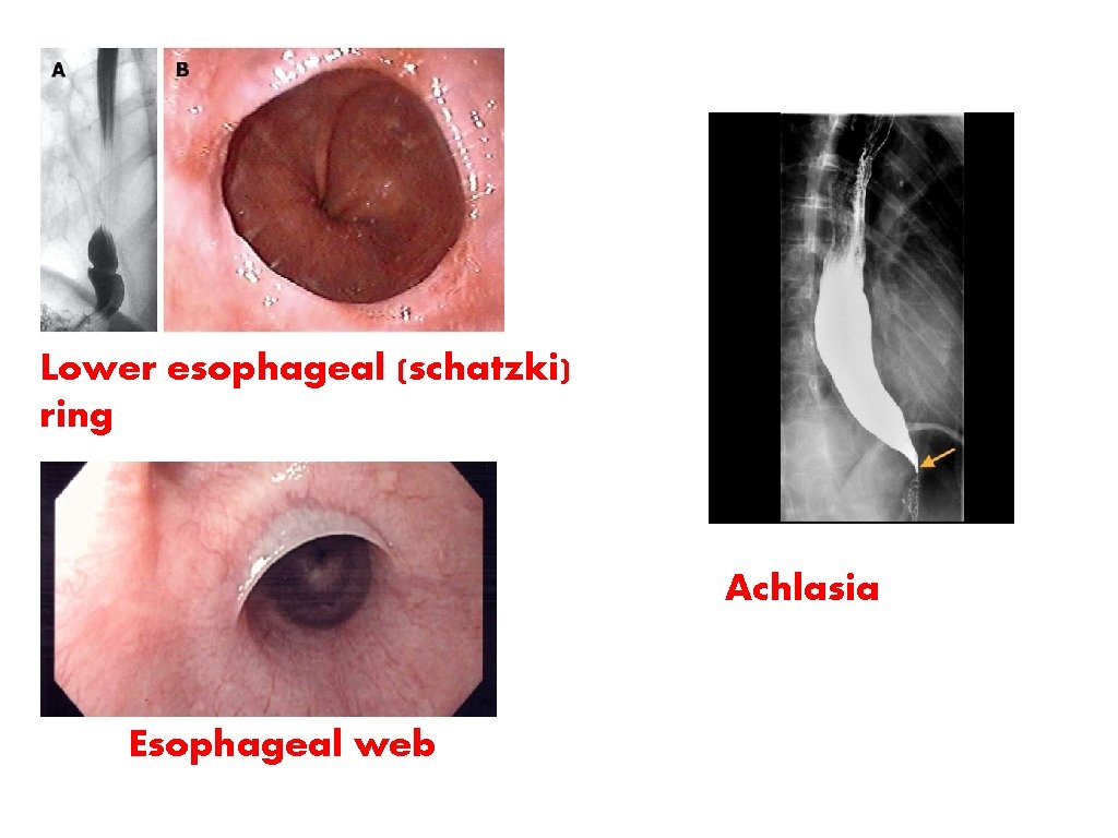 Lower esophageal (schatzki) ring Achlasia Esophageal web 