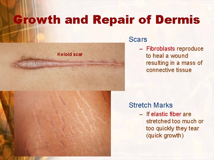 Growth and Repair of Dermis Scars Keloid scar – Fibroblasts reproduce to heal a Growth and Repair of Dermis Scars Keloid scar – Fibroblasts reproduce to heal a