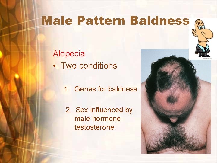 Male Pattern Baldness Alopecia • Two conditions 1. Genes for baldness 2. Sex influenced Male Pattern Baldness Alopecia • Two conditions 1. Genes for baldness 2. Sex influenced