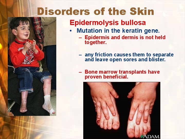 Disorders of the Skin Epidermolysis bullosa • Mutation in the keratin gene. – Epidermis Disorders of the Skin Epidermolysis bullosa • Mutation in the keratin gene. – Epidermis