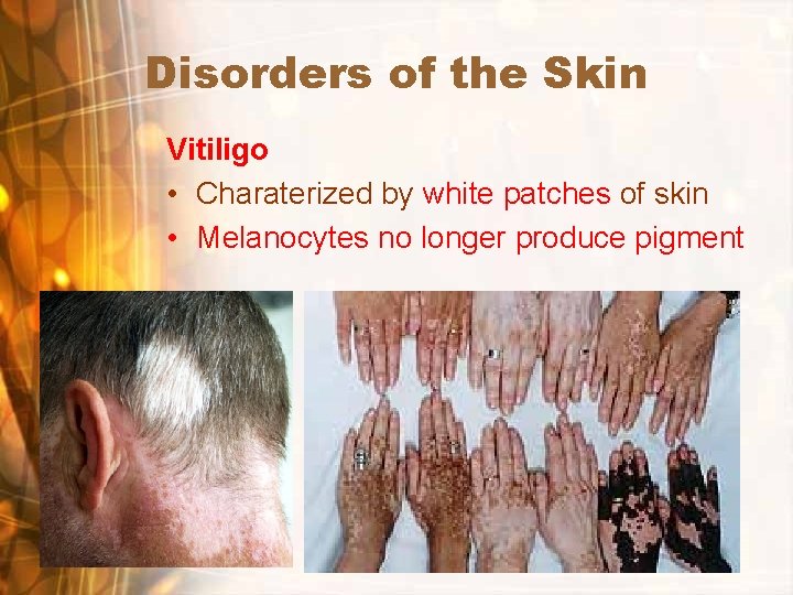 Disorders of the Skin Vitiligo • Charaterized by white patches of skin • Melanocytes Disorders of the Skin Vitiligo • Charaterized by white patches of skin • Melanocytes