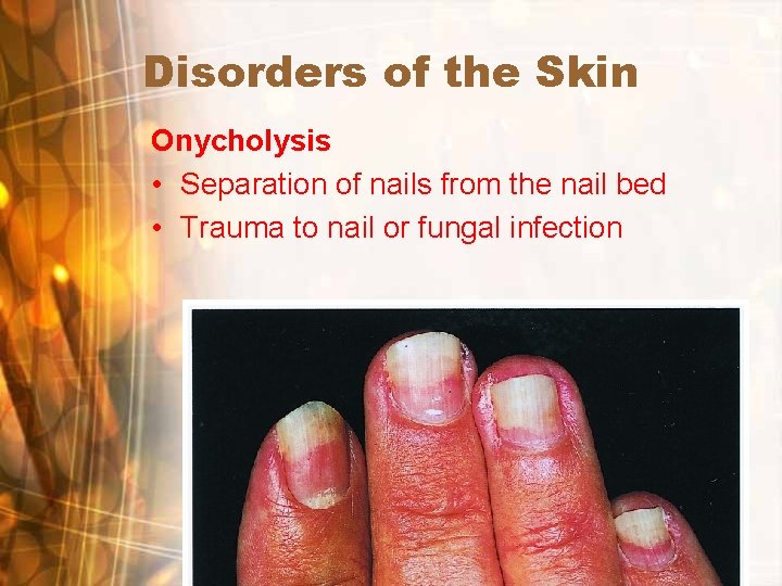 Disorders of the Skin Onycholysis • Separation of nails from the nail bed • Disorders of the Skin Onycholysis • Separation of nails from the nail bed •