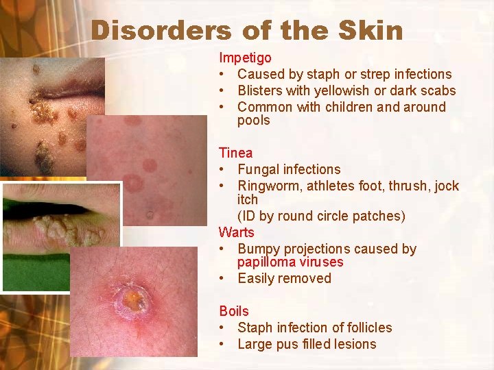 Disorders of the Skin Impetigo • Caused by staph or strep infections • Blisters Disorders of the Skin Impetigo • Caused by staph or strep infections • Blisters