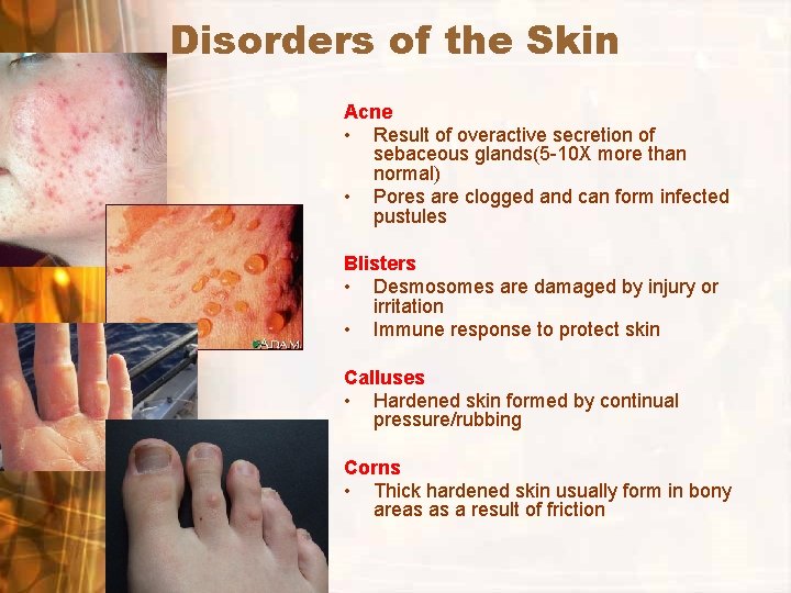 Disorders of the Skin Acne • Result of overactive secretion of sebaceous glands(5 -10 Disorders of the Skin Acne • Result of overactive secretion of sebaceous glands(5 -10
