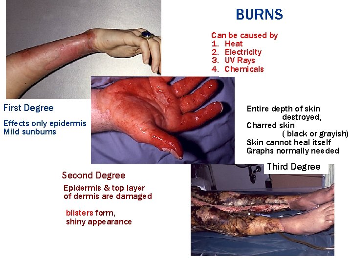 BURNS Can be caused by 1. Heat 2. Electricity 3. UV Rays 4. Chemicals BURNS Can be caused by 1. Heat 2. Electricity 3. UV Rays 4. Chemicals