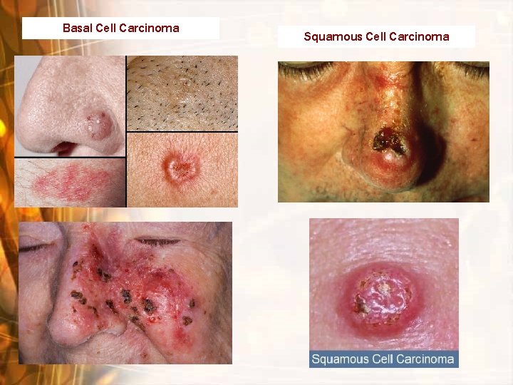 Basal Cell Carcinoma Squamous Cell Carcinoma Basal Cell Carcinoma Squamous Cell Carcinoma