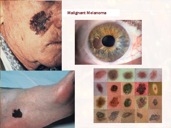 Malignant Melanoma Malignant Melanoma