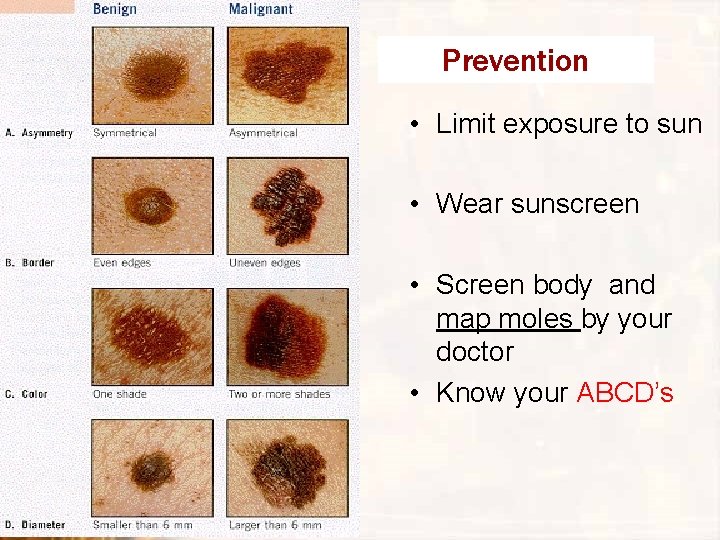 Prevention • Limit exposure to sun • Wear sunscreen • Screen body and map Prevention • Limit exposure to sun • Wear sunscreen • Screen body and map