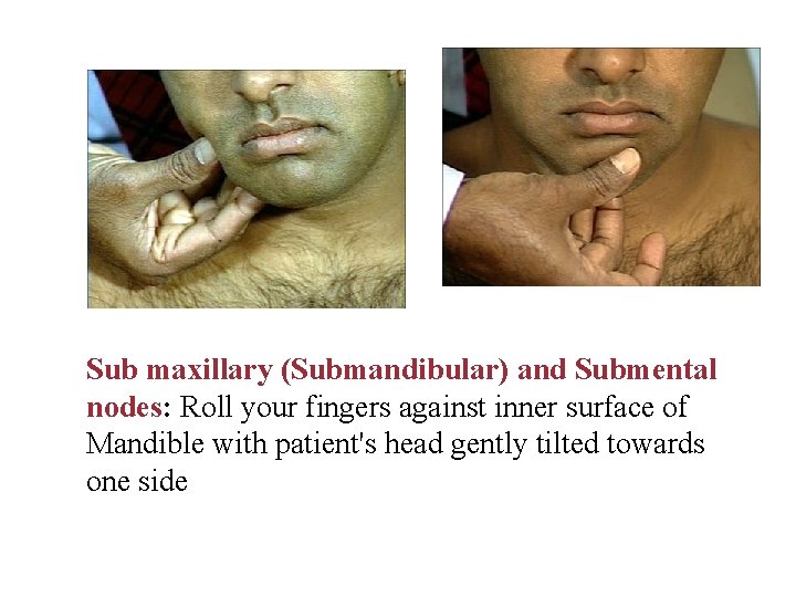 Sub maxillary (Submandibular) and Submental nodes: Roll your fingers against inner surface of Mandible