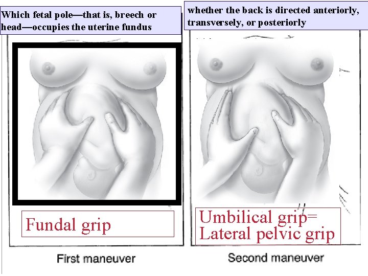 Which fetal pole—that is, breech or head—occupies the uterine fundus Fundal grip whether the