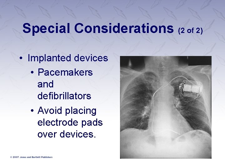 Special Considerations (2 of 2) • Implanted devices • Pacemakers and defibrillators • Avoid