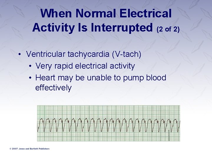 When Normal Electrical Activity Is Interrupted (2 of 2) • Ventricular tachycardia (V-tach) •