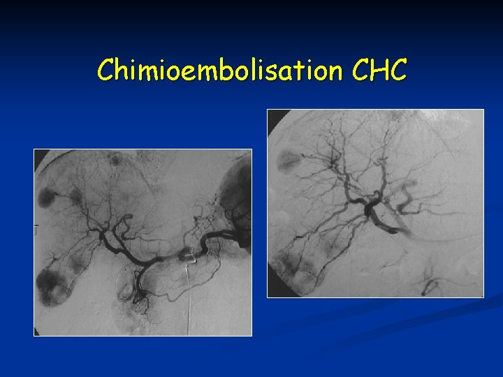 Chimioembolisation CHC 