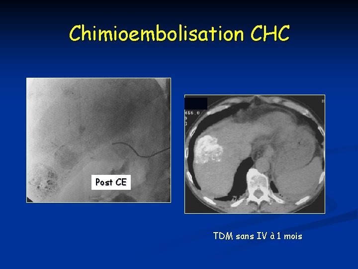 Chimioembolisation CHC Post CE TDM sans IV à 1 mois 