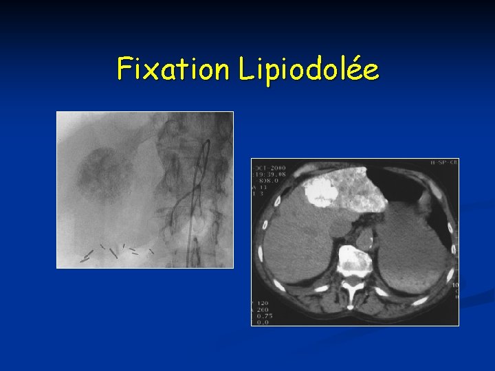 Fixation Lipiodolée 