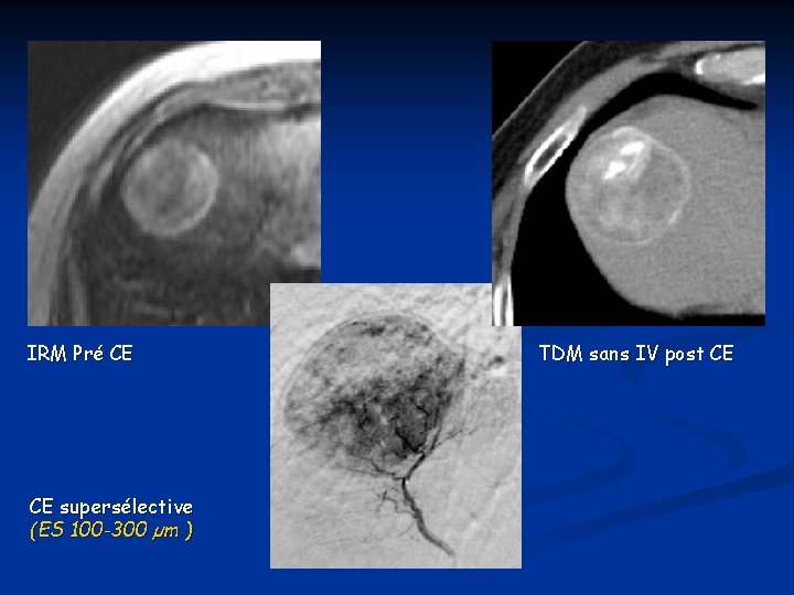 IRM Pré CE CE supersélective (ES 100 -300 µm ) TDM sans IV post